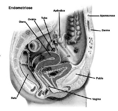 endometriose